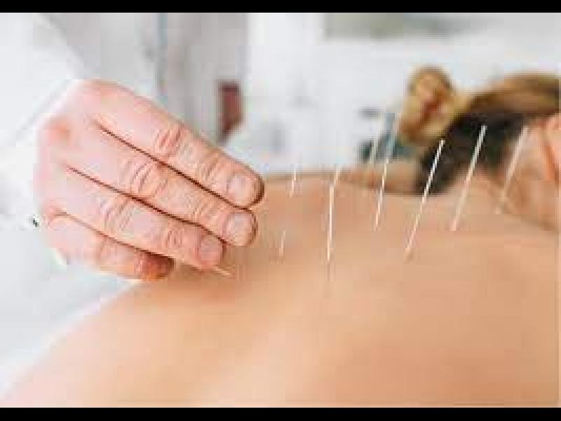 DRY NEEDLING